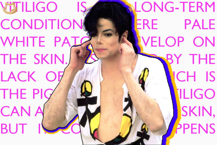 You Are Not Alone – Michael, Vitiligo and Hollywood By Admin Team March 10, 2023 Vitiligo-00-696x464